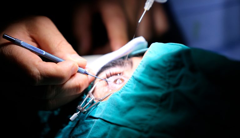 Por que é Importante Fazer Laser para Limpeza da Lente Após a Cirurgia de Catarata